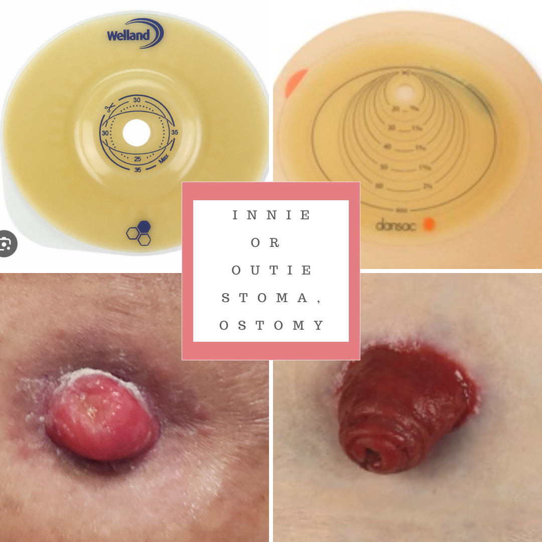 understanding-the-difference-between-innie-and-outie-stomas-ostomy